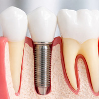 Стоматологическая имплантология