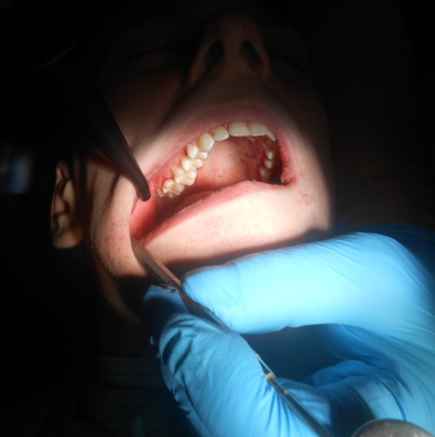 Лечение зубов под наркозом детям вао thumbnail