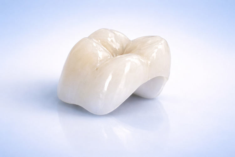 Коронка металлокерамическая